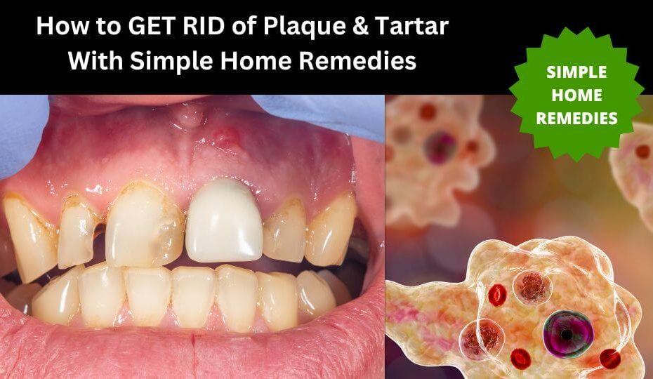 How to get rid of plaques and tartar with simple home remedies